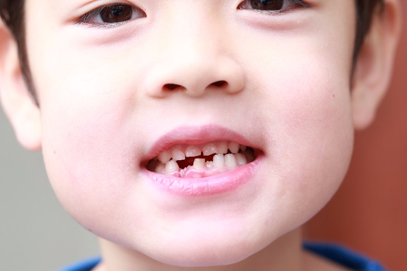 お子さまの矯正治療のタイミング